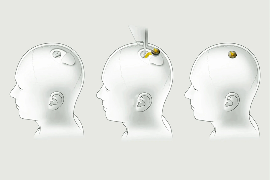 Маск анонсировал испытания импланта в мозге на людях